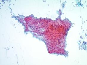 Oncocytic Tumors Oncocytoma Acinic cell carcinoma Salivary duct