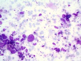 aspirate with features highly suggestive but not unequivocal for malignancy Type of malignancy favored or differential diagnosis should