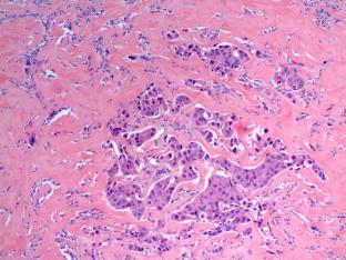 High grade salivary duct carcinoma Management Not equivalent to malignant Repeat FNA, biopsy or excision may be considered Consider ancillary
