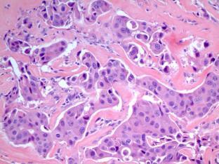primary and secondary neoplasms Parotid and submandibular glands For primary malignancies: Low grade carcinoma High grade carcinoma Cell blocks