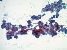 Low Grade Carcinomas Acinic cell carcinoma