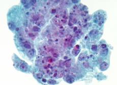 diagnosis of a high grade salivary gland carcinoma is often not