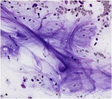 III. Atypia of Undetermined Significance (AUS) Limited cytologic atypia Indefinite for neoplasm Should represent <10% of