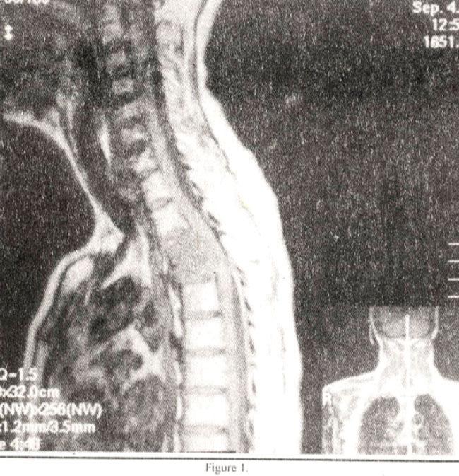Metastatic disease or tuberculosis was suspected. Decompressive surgery was performed with removal of T3 and T4 vertebral bodies and insertion of fibular graft between T2 and T5.