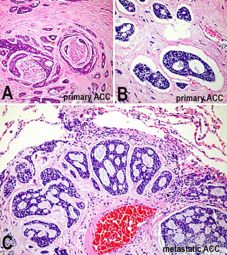 Nagano CP, Coutinho-Camillo CM, Pinto CA, et al. Figure 2. Photomicrography of the histopathological aspects of primary and metastatic adenoid cystic carcinoma.