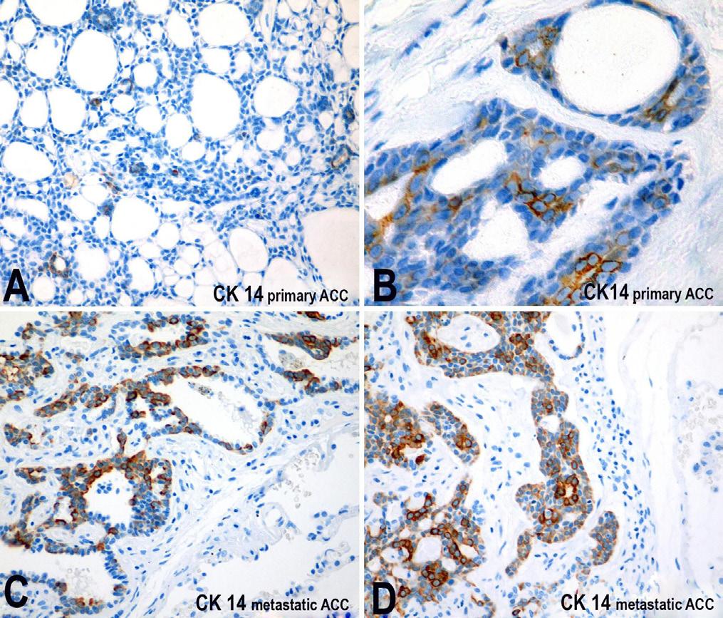 Cytokeratin immunoprofile of primary and metastatic adenoid cystic carcinoma of salivary glands: a report of two cases Figure 4.