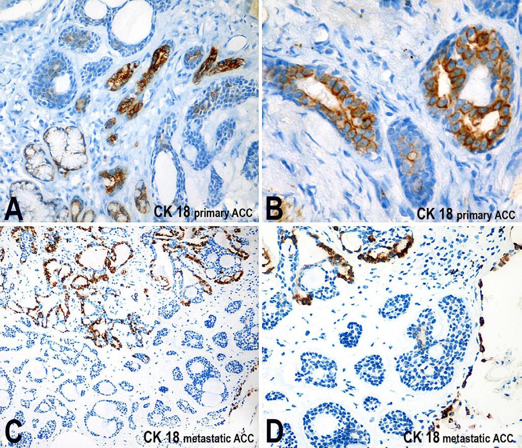 A - A few luminal structures positive for CK14 in the primary ACC; B - Cribriform nest of the primary mass showing a greater number of luminal structures positive for CK14.