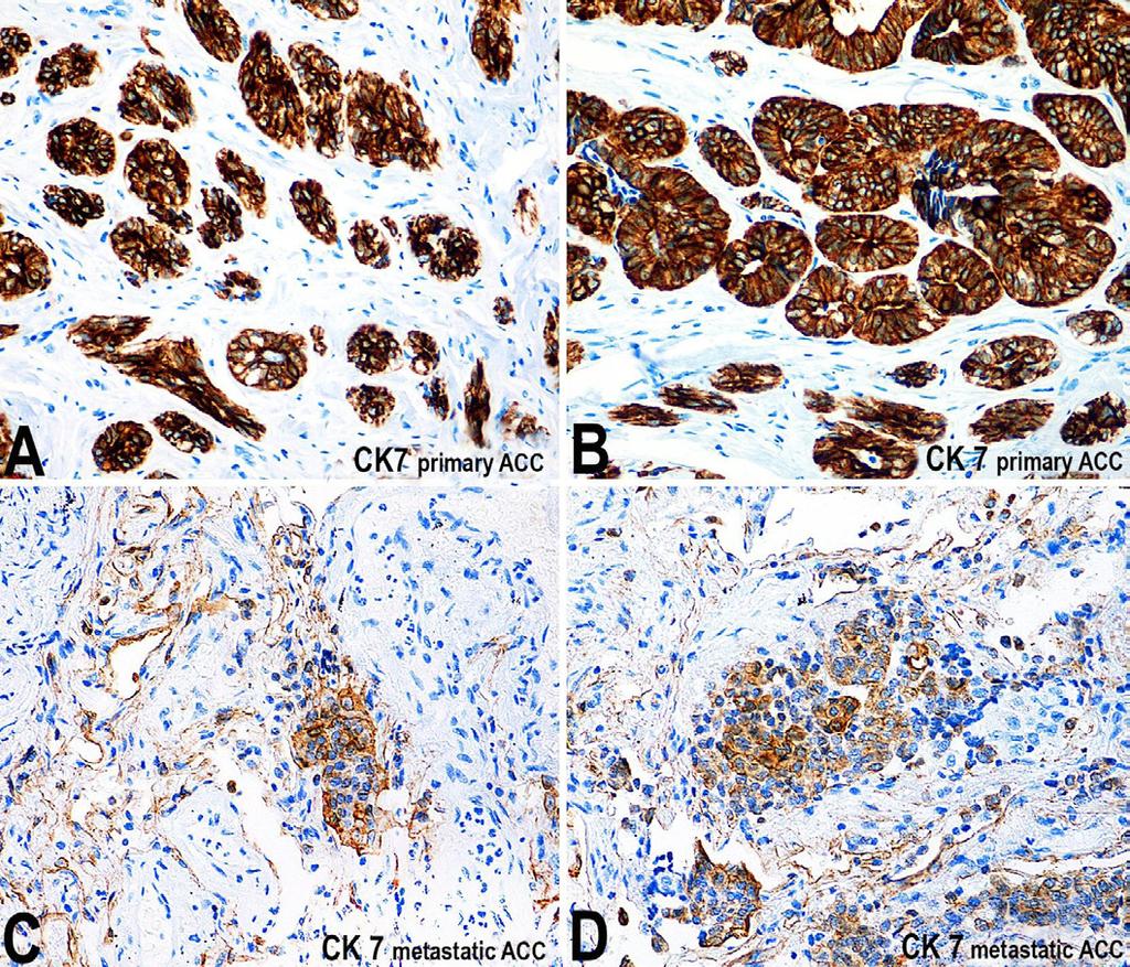 Nagano CP, Coutinho-Camillo CM, Pinto CA, et al. Figure 8. Photomicrography of the expression of CK7 (clone LL002, AbCAM) in the primary and metastatic adenoid cystic carcinoma (ACC).