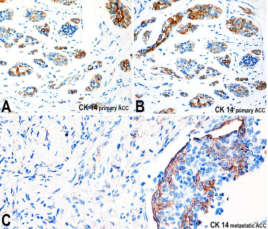 Immunohistochemistry revealed with DAB (100X, 250X, 100X, and 200X, respectively). Figure 10.
