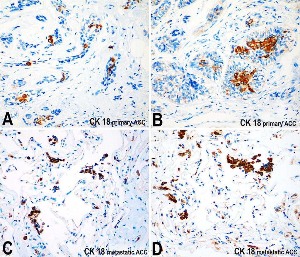 A and B - In the primary mass, scattered cells are highly positive for CK18; C and D - Small neoplastic nests within the metastatic mass are positive for CK18.