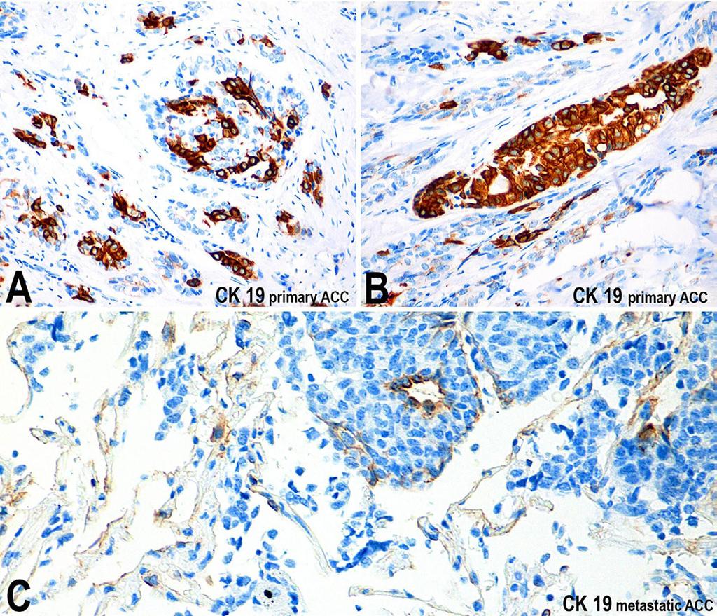 Photomicrography of the expression of CK14 (clone RCK105, AbCAM) in the primary and metastatic adenoid cystic carcinoma (ACC).