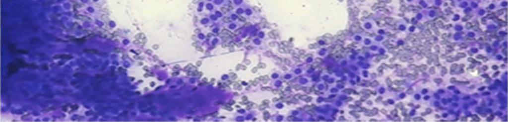 In the nonneoplastic and malignant neoplastic cases, 100% correlation was found between the two
