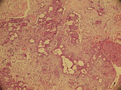 2 Pathology Research International Figure 1: Benign mixed tumor (pleomorphic adenoma) with a biphasic admixture of epithelium and stroma (H&E 200).