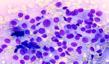 Neoplastic: SUMP Myoepithelioma Neoplastic: SUMP Basal Cell Neoplasm- DDX basal cell adenoma, cellular PA, AdCC Suspicious for Malignancy