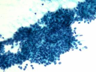 Salivary Gland FNA- Pleomorphic Adenoma 4 Salivary Gland FNA