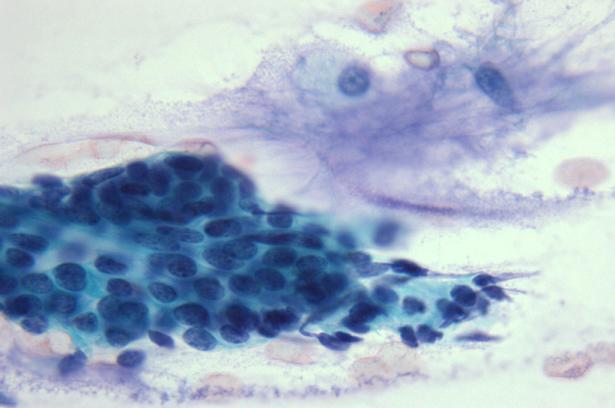 Cluster of Ductal Cells Different Appearances