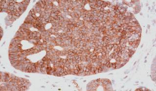 Adenoid Cystic Carcinoma Immunohistochemistry: Over 90% are strongly positive for CD117 (KIT) Useful for all variants including solid