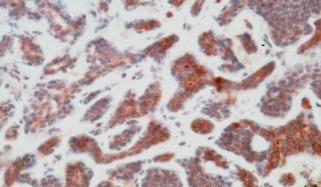 have not been detected Adenoid Cystic Carcinoma: Recent Advance MYB Translocation Cytogenetics: t(6:9) MYB oncogene-nfib transcription