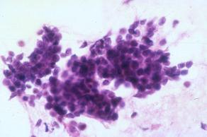 Classic Pleomorphic Adenoma vs Classic Adenoid Cystic Carcinoma Pleomorphic Adenoma - predominance of myoepithelial cells - minimal