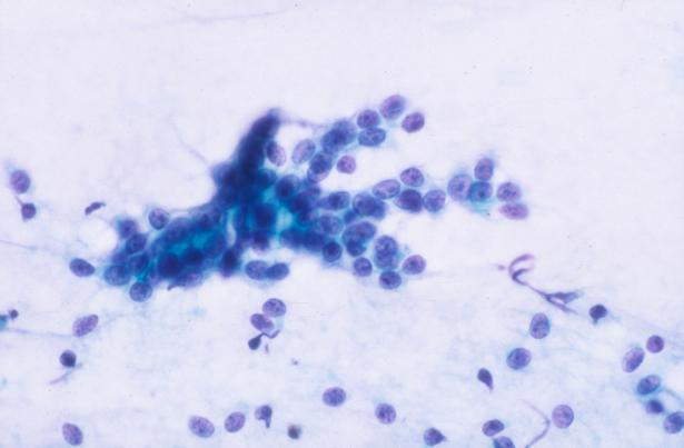 papillary Scant matrix Polymorphous Low-Grade Adenocarcinoma: No specific molecular