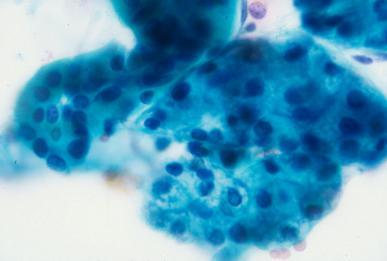 FNA OF THE NORMAL SALIVARY GLAND Intercalated duct Acinar cells NORMAL SALIVARY GLAND FNA For aspirates containing only normal