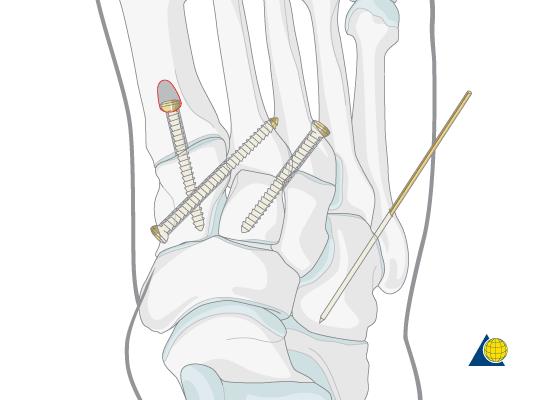 When the more medial TMT joints are reduced, the 4th and 5th TMT joints often move medially and are reduced along with the rest of the foot.
