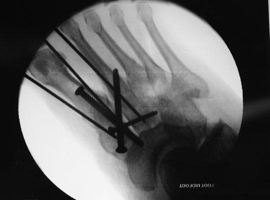Intertarsal instabilities can be addressed before the Lisfranc injury is fixed. Any instabilities can be compressed with the pointed reduction forceps and held with K-wires.