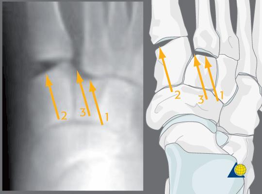 1. Lateral displacement of 2nd metatarsal on intermediate cuneiform 2. TMT 1 disruption 3.