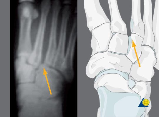 Lateral displacement of 3rd metatarsal on lateral cuneiform X-rays lateral view https://www2.aofoundation.