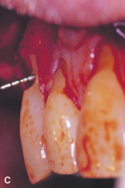 E) The mucogingival flap is coronally advanced over the root surface and sutured.