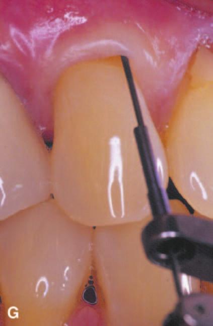 Comparison of Connective Tissue Versus EMD Grafts Volume 74 Number 8 1120 Figure 8. (cont.) G) Probing depth measurements on the test tooth at 12 months.
