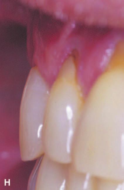 H) A profile photograph of the test tooth at 12 months demonstrating the creation of a proper soft tissue to tooth emergence profile despite the significant root surface abrasion.