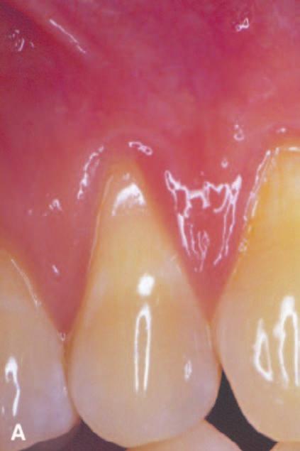 B) Clinical appearance of the test tooth at 12 months. Note not only the root coverage, but also the increase in keratinized tissue as compared to the preoperative photograph A.