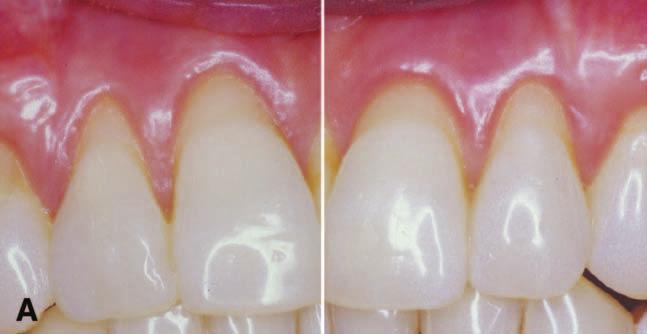 J Periodontol August 2003 McGuire, Nunn Figure 2. A) Baseline appearance of the maxillary lateral incisors which were randomized to receive the test (left) or control (right) treatment.