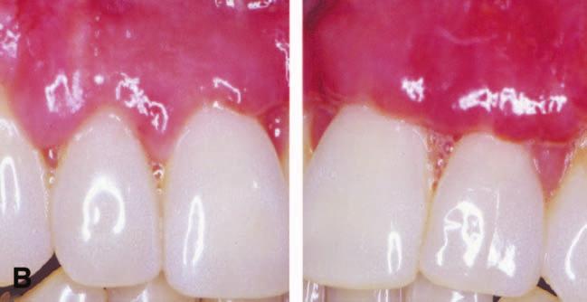 C) Test (left) and control (right) teeth at 4 weeks, the test treatment continues to exhibit superior wound healing.