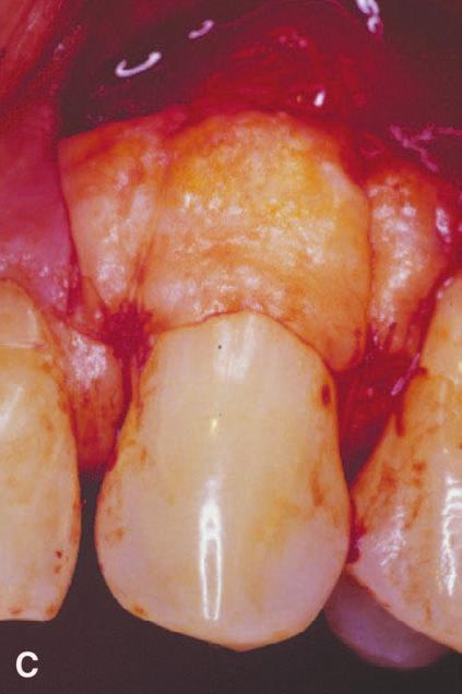 D) The mucogingival flap is coronally advanced over the subepithelial connective tissue graft