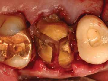 Figure 29: Setpal bone at site #3 remains intact following tooth removal bone and beyond the apex of the tooth socket.