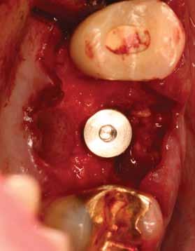 Figure 30: Placement of dental implant into maxillary septal bone. Figure 31: Placement of bone allograft.
