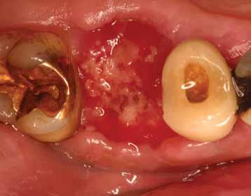 The morphology of the socket at the time of extraction may complicate optimal placement and initial