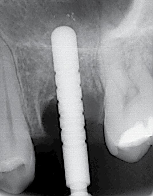 Figure 17: Immediate implant placed in interradicular bone. Figure 16: Sinus lift elevation with a 3 mm osteotome.