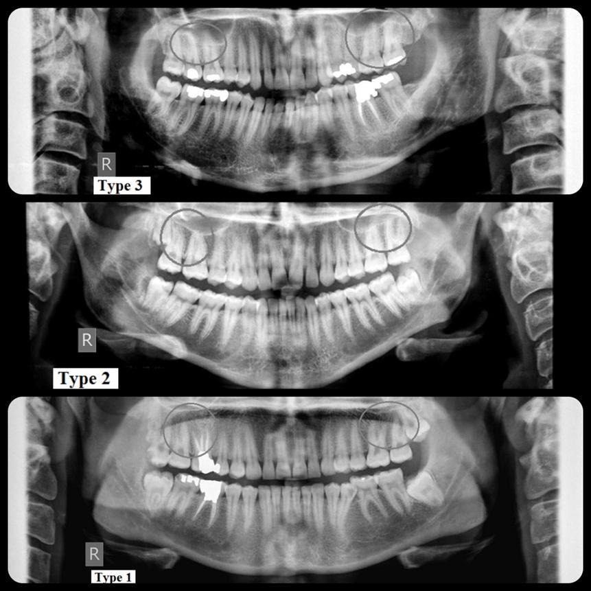 lamina dura continuity was used to distinguish between type 3 and 4. One observer (an oral and maxillofacial radiologist) measured the mentioned distances.