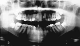 In such cases, the FPM may be retained until the second permanent molar erupts.