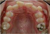 teeth. In the mandibular arch, the posterior teeth protract while the mandibular incisors upright.