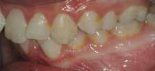 This film is pre extraction space closure and pre Forsus corrector placement.