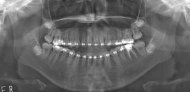 Why four 2 nd molars are extracted? 1. To eliminate the wedge effect 2. To solve the posterior crowding 3.