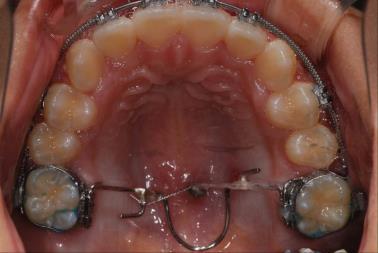 1. Single molar intrusion A. Inter-radicular mini-implants B. Midpalatal mini-implant + TPA 2. Maxillary posterior teeth intrusion 3. Total maxillary intrusion 4. Canting correction 5.