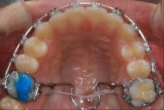 Structure Advantages of Method 5 1. A mid-palatal mini-implant is more stable than a buccal mini-implant between 6 and 7. 2.
