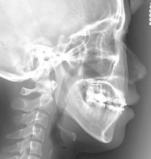A. Single molar intrusion 00/00 A. Single molar intrusion 00/00 B. Maxillary posterior teeth intrusion B. Maxillary posterior teeth intrusion A. Midpalatal mini-implant + TPA 55/55 A.