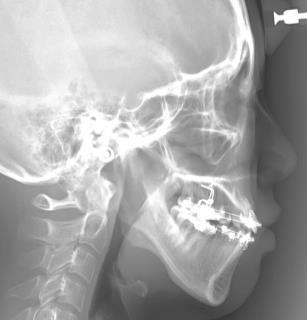 Total maxillary intrusion 44/55 C. Total maxillary intrusion 44/55 D. Canting correction D. Canting correction E. Four clinical tips for open bite correction 44/00 E.