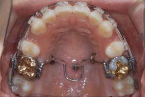 To intrude posterior teeth only, place the mini-implant distally!